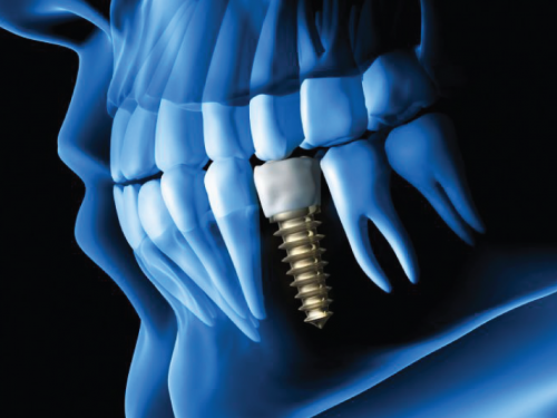 Dental Implants Services Centre Dentaire Ville De Quebec Dentistes Quebec City Dental Center Dentist